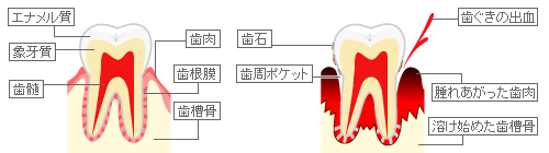 歯周組織−正常な歯(左)と歯周病に侵された歯(右)